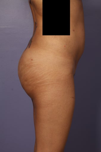 Buttock augmentation 