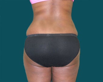 Buttocks augmentation with implants and fat grafting