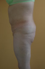 Butt Augmentation