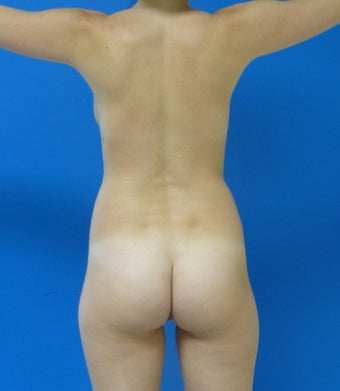 Brazilian butt Lift