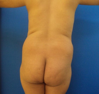 Brazilian Butt lift