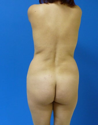 Brazilian Butt Lift