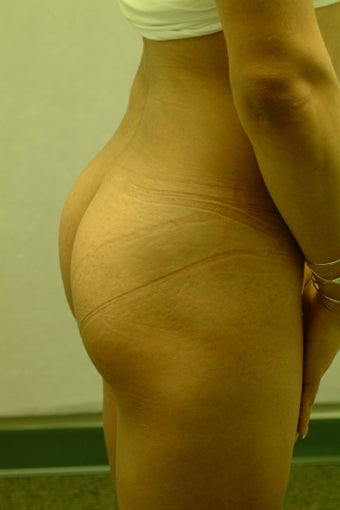 Brazilian Butt Lift/Implants