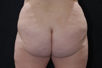 Buttock Augmentation through Fat Transfer