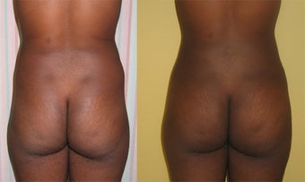 Buttock Augmentation 
