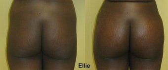 Buttock Augmentation
