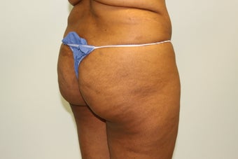 But augmentation