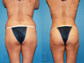 Buttock Augmentation with fat transfer, liposuction abdomen and hips