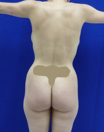 Butt Augmentation