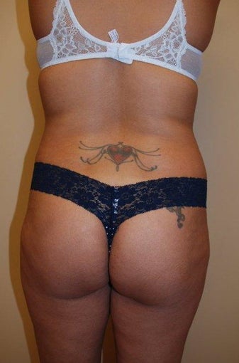 Buttock Augmentation