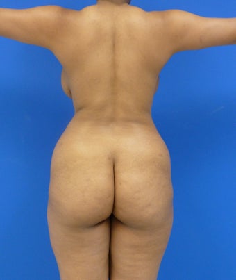 Buttock Augmentation