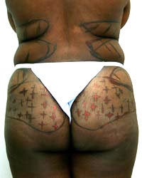 Liposuction and Buttock augmentation