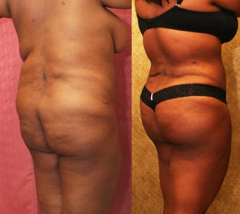 Brazilian buttock augmentation with fat grafting to the buttocks with liposuction in Los Angeles