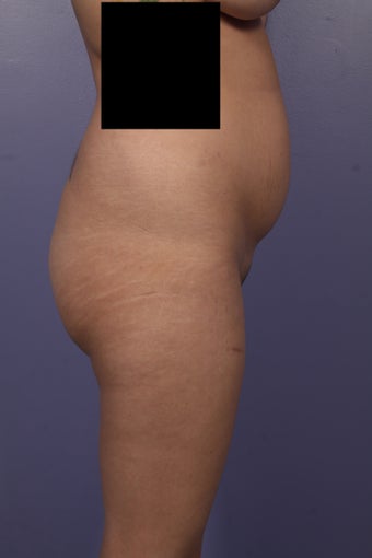 Buttock augmentation 