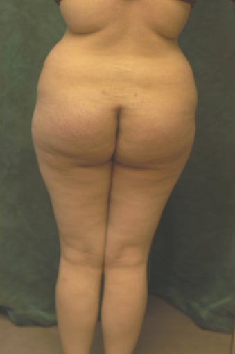 Buttocks Augmentation