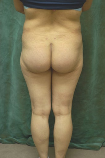 Women's Buttocks Augmentation 