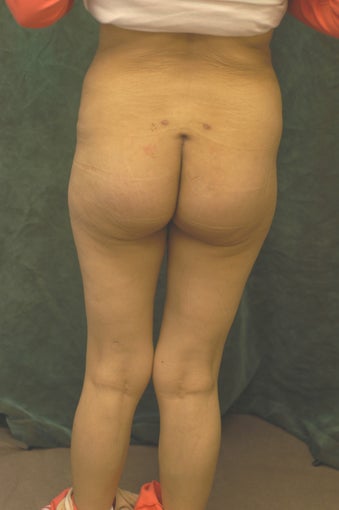 Women's Buttocks Augmentation