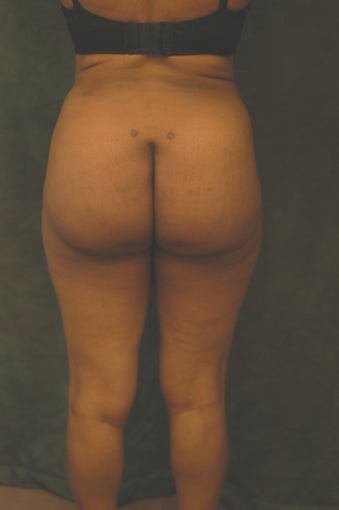 Women's Buttocks Augmentation 