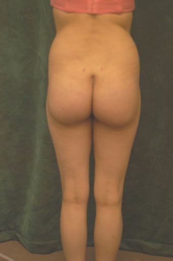 Women's Buttocks Augmentation 