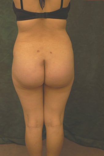 Women's Buttocks Augmentation  