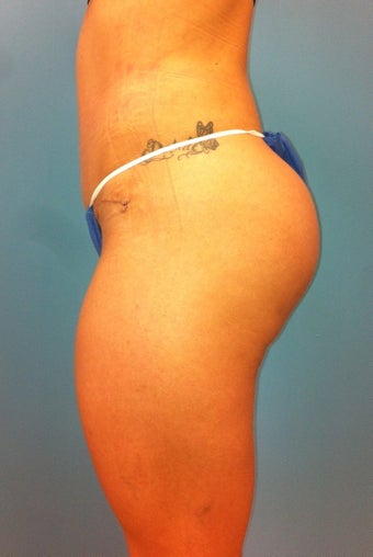 Gluteal Implants