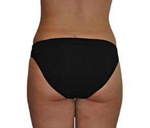 Butt Augmentation (Implants)