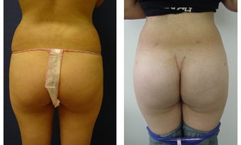 Buttocks Implants