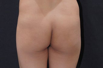 Buttock Augmentation with Gluteal Implant