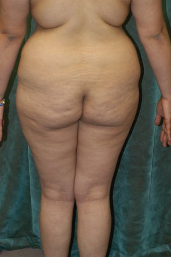 Buttocks Augmentation