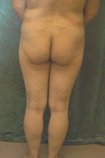 Women's Buttocks Augmentation 