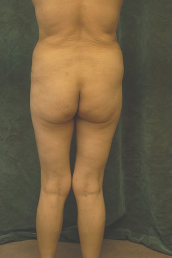 Women's Buttocks Augmentation