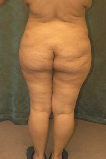 Women's Buttocks Augmentation 