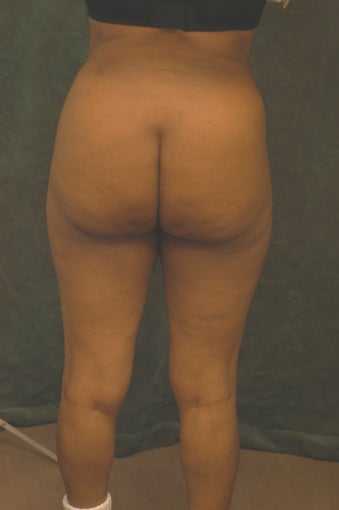 Women's Buttocks Augmentation 