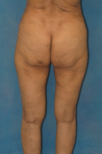 Women's Buttocks Augmentation 