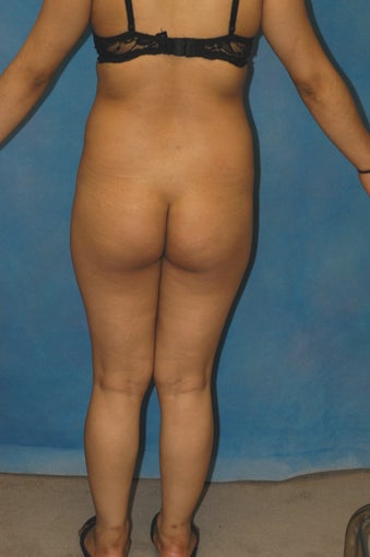 Women's Buttocks Augmentation