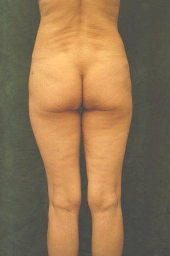 Women's Buttocks Augmentation  