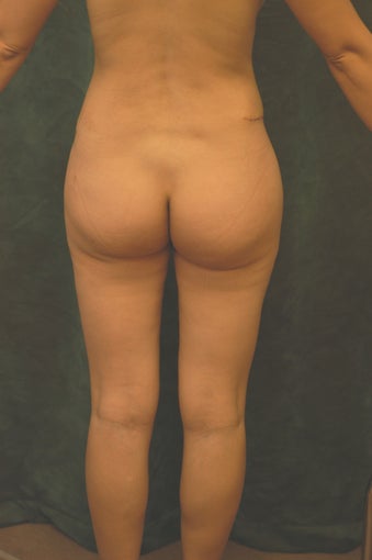 Women's Buttocks Augmentation  