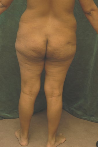 Women's Buttocks Augmentation