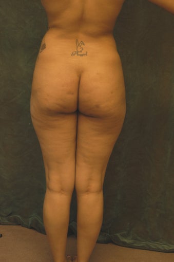 Women's Buttocks Augmentation