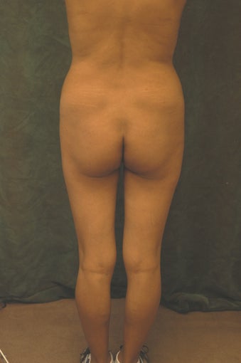 Women's Buttocks Augmentation  