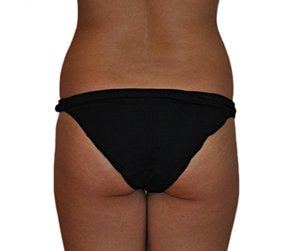 Butt Augmentation (Implants)