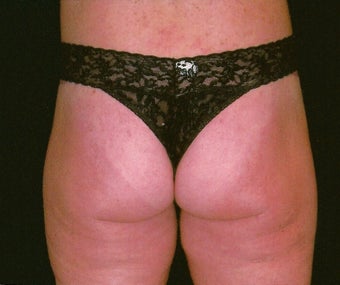 Buttock and flank lift for massive weight loss