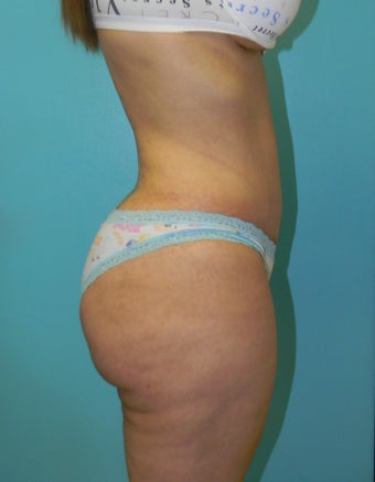 Brazilian Butt Lift- Fat transfer