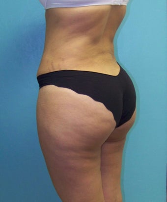 Brazilian Butt Lift- Fat Transfer