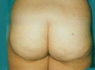 Butt lift