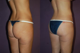 Butt Lift