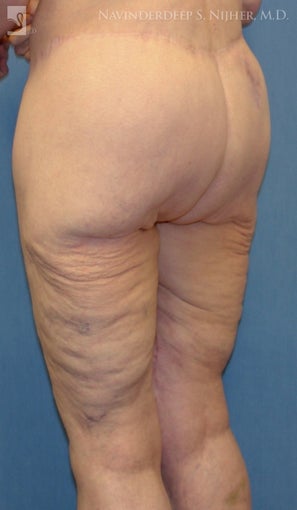 Backlift