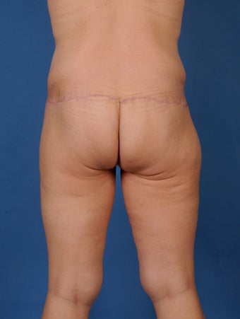 Buttock Lift