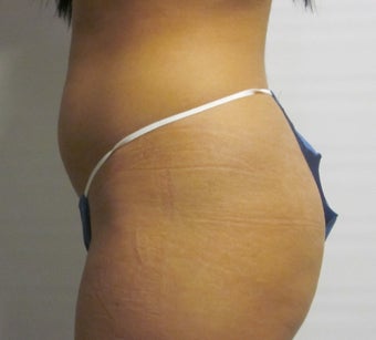 Brazilian Butt Lift 