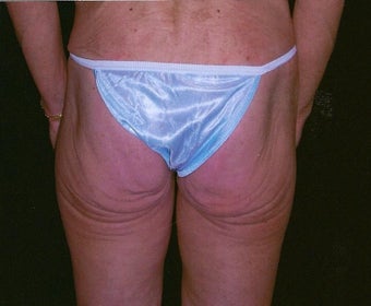 Buttock and flank lift for massive weight loss